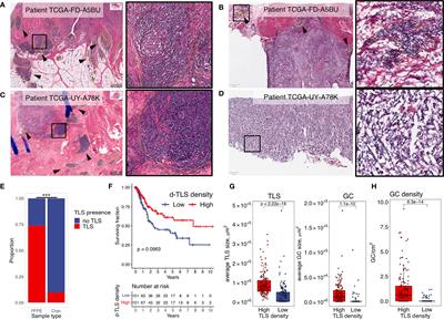 Molecular, Immunological, and Clinical Features Associated With Lymphoid Neogenesis in Muscle Invasive Bladder Cancer